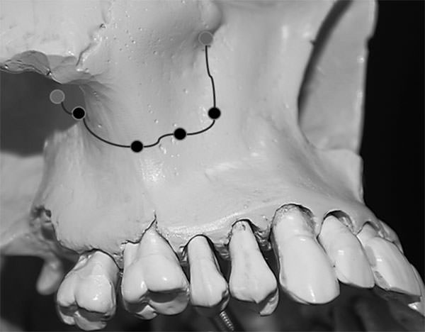 Figura 2 Localización intraosea promedio de acuerdo a nuestros resultados de paquete vascular alveoloantral