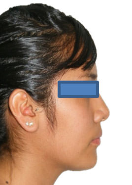 Fig. 2 Extraoral de perfil