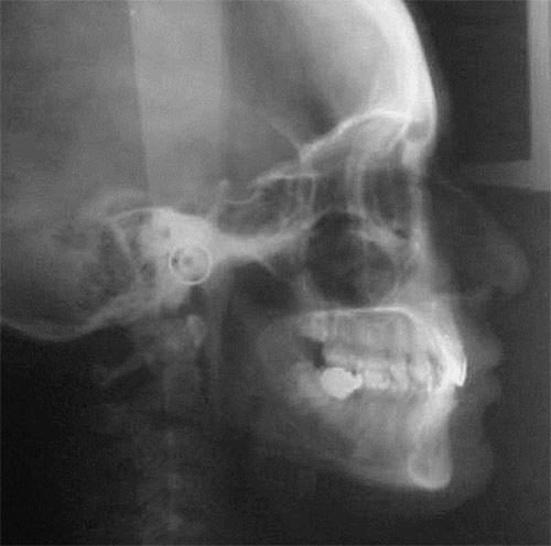 Fig. 6 Radiografía lateral de cráneo