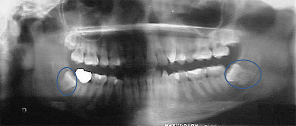 Fig. 7 Radiografía panorámica, con algunas piezas dentarias obturadas