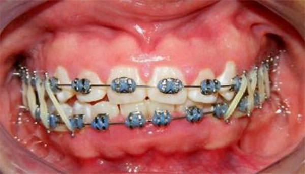 Fig. 8 Progreso intraoral de frente