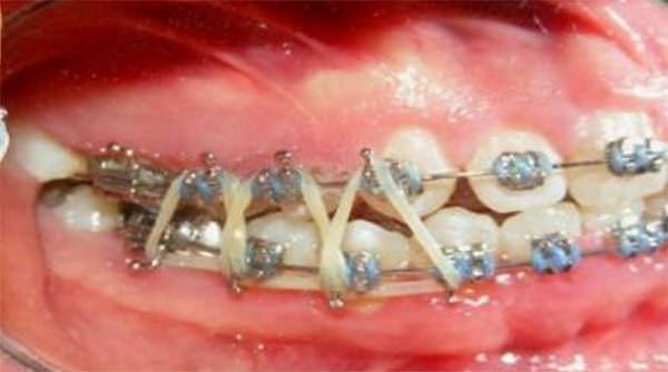 Fig. 9 Progreso intraoral derecha