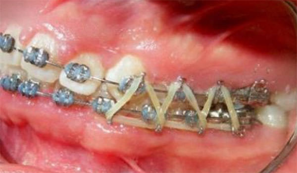 Fig. 10 Progreso intraoral izquierda