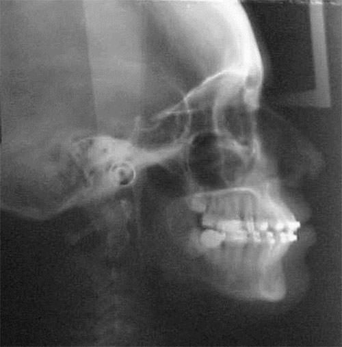 Fig. 11 Radiografía lateral de cráneo de progreso