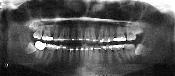Fig. 12 Radiografía panorámica de progreso