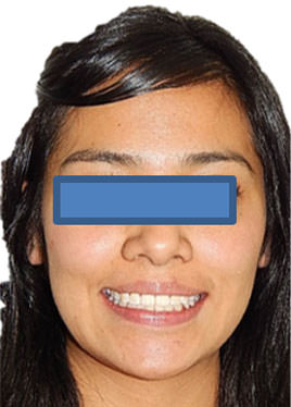 Fig. 13 Extraoral de sonrisa