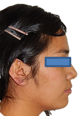 Fig. 14 Perfil