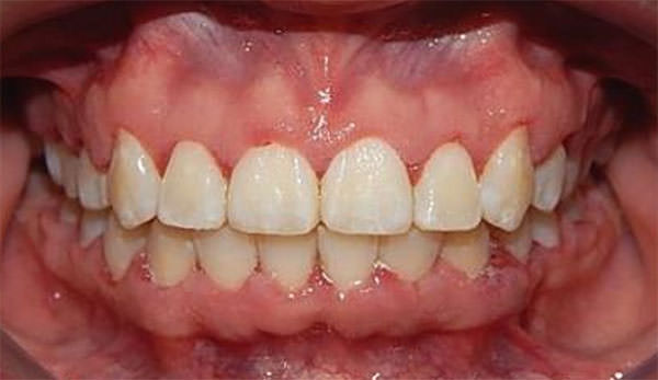 Fig. 15 Fotografía intraoral final de frente