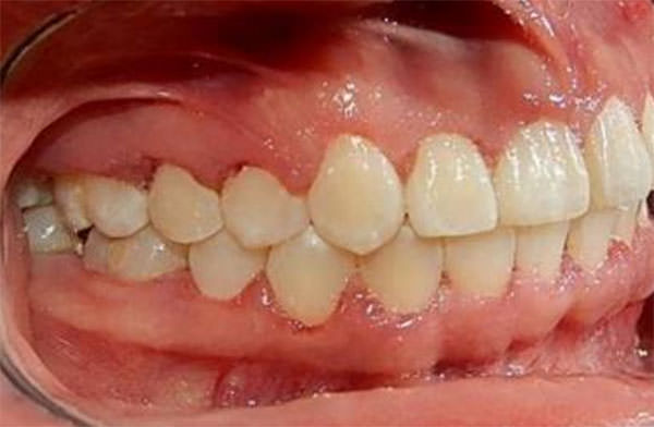 Fig. 16 Intraoral lateral derecha final