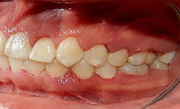 Fig. 17 Lateral izquierda final