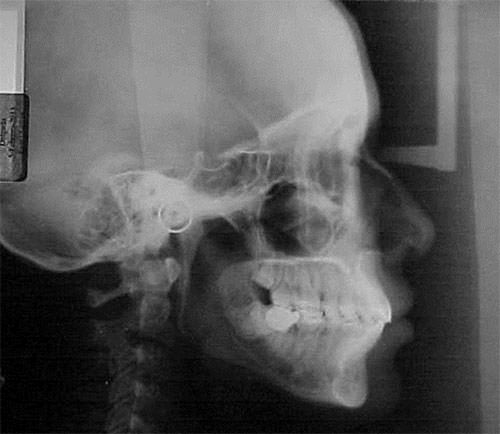 Fig. 18 Radiografía lateral de cráneo final