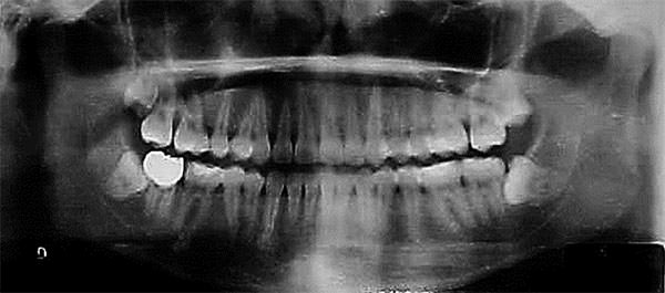 Fig. 19 Radiografía Panorámica