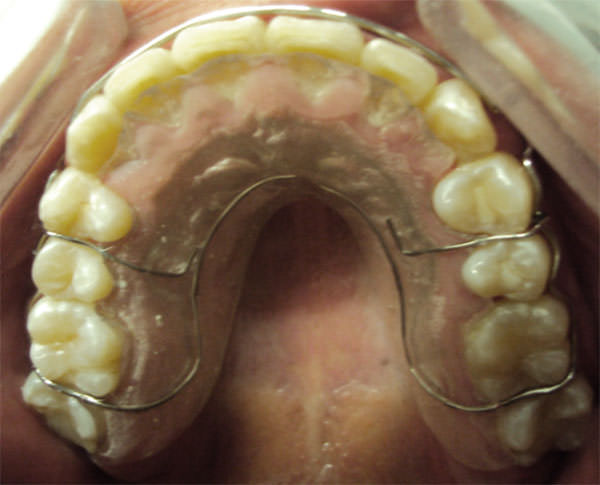 Fig. 21 Retenedor circunferencial superior