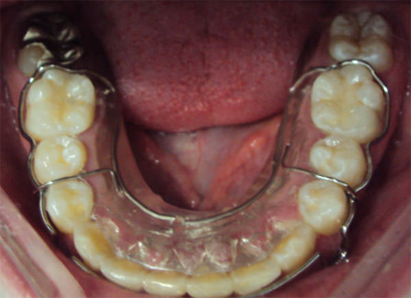 Fig. 22 Circunferencial inferior