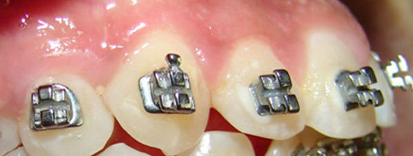 La estructura principal de los brackets Biofuncionales está formada con la doble capa de aletas; las aletas principales en la parte más externa, las aletas auxiliares en la porción media. Puede usarse con ligaduras metálicas o con ligaduras elastoméricas de color si así lo desea el paciente.