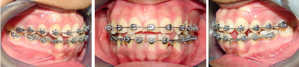 Retracción del segmento anterior por deslizamiento para mantener el torque activo en los dientes