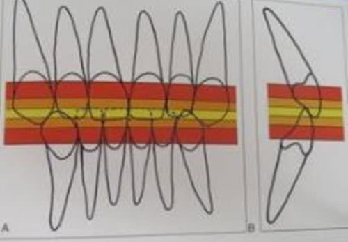 Fig. 1 Zonas de la sobremordida vertical. De 5% a 25% es normal (color amarillo). 25% a 40% es una sobremordida vertical aumentada (color naranja). Mayor de 40% es una sobremordida vertical excesiva (color rojo). A. Vista Frontal. B. Vista lateral. 3