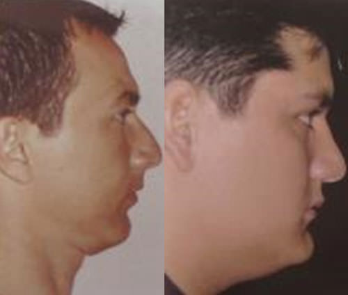 Fig.2 Perfil cóncavo debido a la mordida profunda Tercio inferior de la cara disminuido. 7