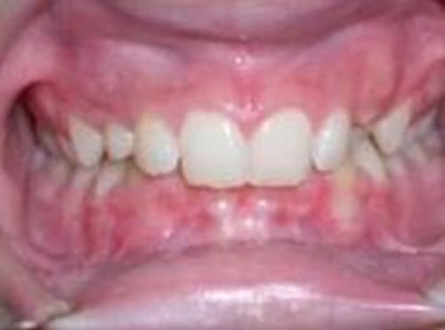 Fig. 3 Alteraciones en la integridad periodontal Dentición permanente