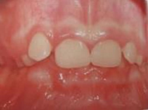 Fig. 4 Alteraciones en la integridad periodontal Dentición mixta Fuente: propia