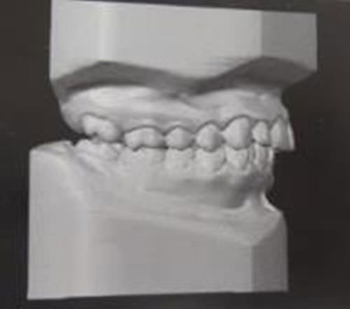 Fig. 5 Clase II canina, mordida profunda. 7