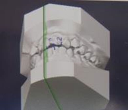Fig. 6 Retroclinación de los incisivos.7