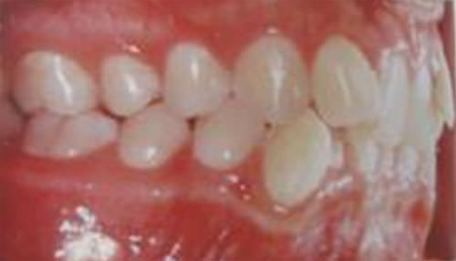 Fig. 7 Molares en Clase I y mordida profunda anterior. 7