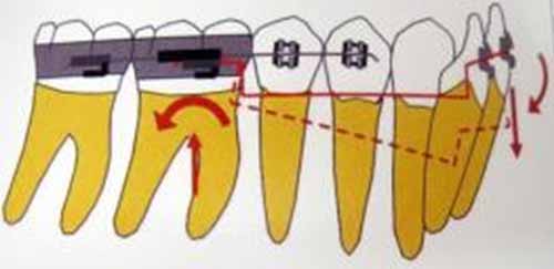 Fig. 11 Diseño biomecánico de la intrusión de los incisivos inferiores con el arco utilitario de Ricketts. 3