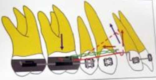 Fig. 13 Biomecánica del arco de intrusión de tres piezas para la simultánea intrusión y retracción de incisivos maxilares. 3