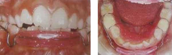 Figs. 16 y 17 Lip Bumper 7