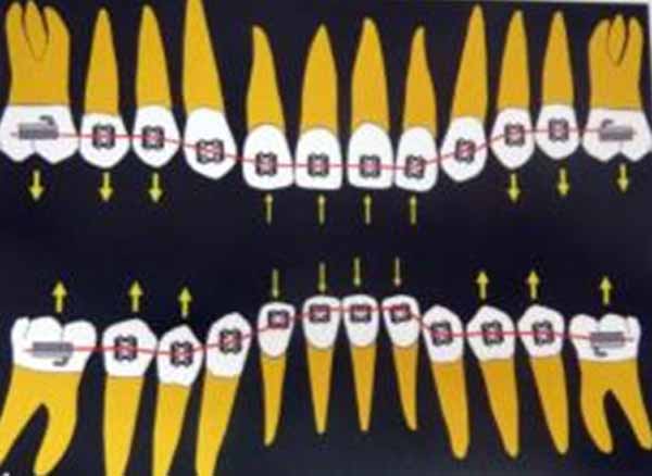 Fig. 19 La intrusión simultánea de los dientes anteriores y la extrusión de los dientes posteriores puede llevarse a cabo por el posicionamiento incisal de los brackets anteriores con respecto a los brackets posteriores. 3
