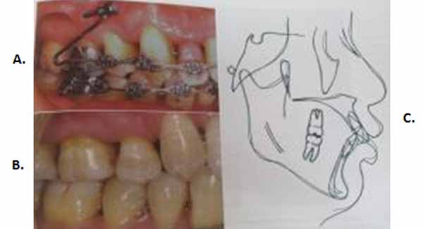 Fig. 20 A. Anclaje óseo para la retrusión de incisivos maxilares protruidos con pérdida ósea en posterior por enfermedad periodontal. B. Retrusión completada, manteniéndose la relación molar de Clase I. C. Superposiciones cefalométricas en la base del cráneo y maxilar que muestran la retrusión de los incisivos maxilares sin movimiento anterior de los dientes posteriores. 5