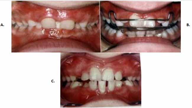 Fig. 23 Activador o Bionator. A-B: previo al tratamiento (inflamación de la encía palatina y vestíbulo-inferior). C: relaciones dentales al concluir la fase I del tratamiento, 12 años de edad. 5