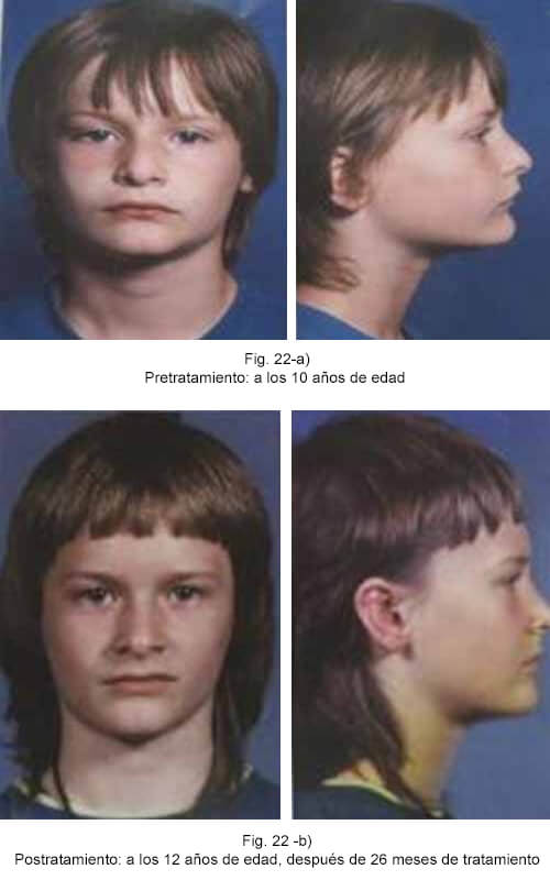 Fig. 22 Cambios faciales producidos por el tratamiento con aparatos funcionales en un niño con cara corta y maloclusión esquelética de mordida profunda. Postratamiento, se observa aumento de la altura facial anterior y disminución del pliegue labiomentoniano. 5