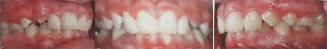 Fig. 24 Mordida cubierta. 4