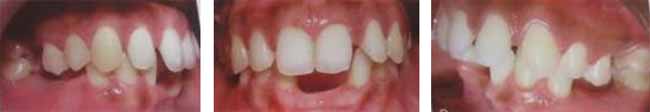 Fig. 25 Mordida cerrada. 3, 4