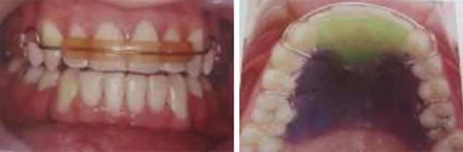 Fig. 27 Retenedor circunferencial con bite plane. 3,7