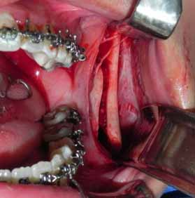 Fig 16 Osteotomía sagital izquierda