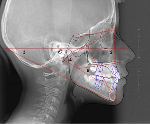 Figura 2 Ángulos para determinar el VERT: 1. Eje facial, 2. Profundidad facial, 3. Ángulo del plano mandibular, 4. Arco mandibular, 5. Altura facial inferior. Fuente: propia