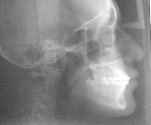 Figura 12 Radiografía lateral de cráneo.