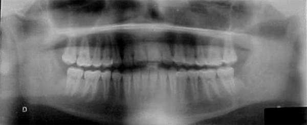 Figura 16 Radiografía panorámica final.
