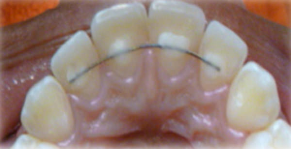 Figura 18 Intraoral oclusal superior