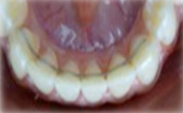 Figura 19 Intraoral inferior con retenedor fijo.
