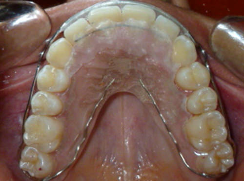 Figura 20 Intraoral oclusal superior