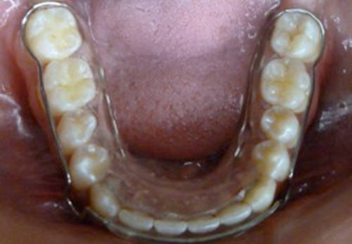 Figura 21 Intraoral oclusal superior