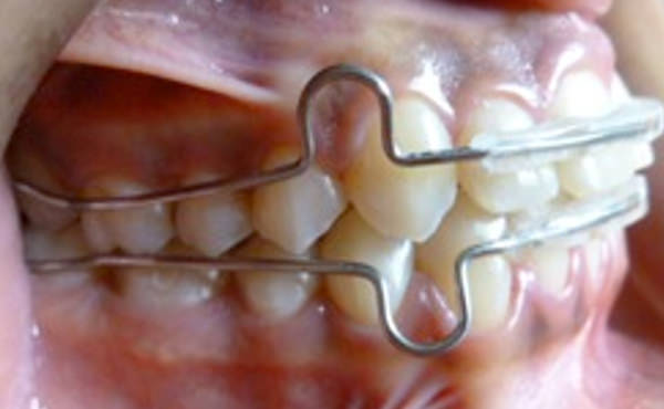Figura 22 Intraoral lateral derecha final con retenedor circunsferencial.