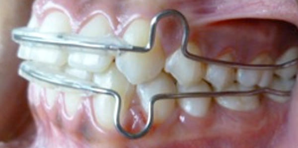 Figura 23 Intraoral lateral izquierda final con retenedor circunsferencial.