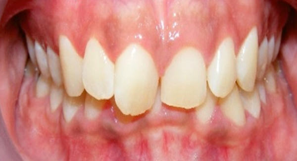 Figura 3 Intraoral de frente