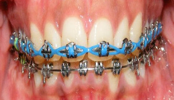 Figura 8 Intraoral frente progreso