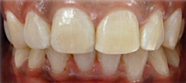 Figura 13 Intraoral de frente de final